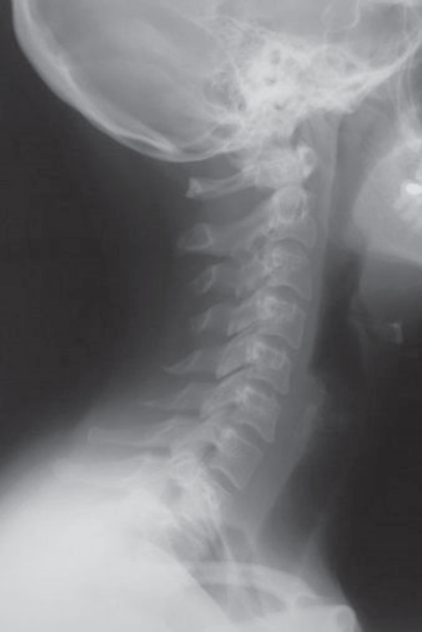 Radiografia lateral de um pescoço e da base do crânio: as vértebras cervicais e a mandíbula aparecem claras contra os tecidos moles escuros.